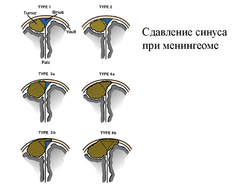 Сдавление синуса при менингеоме